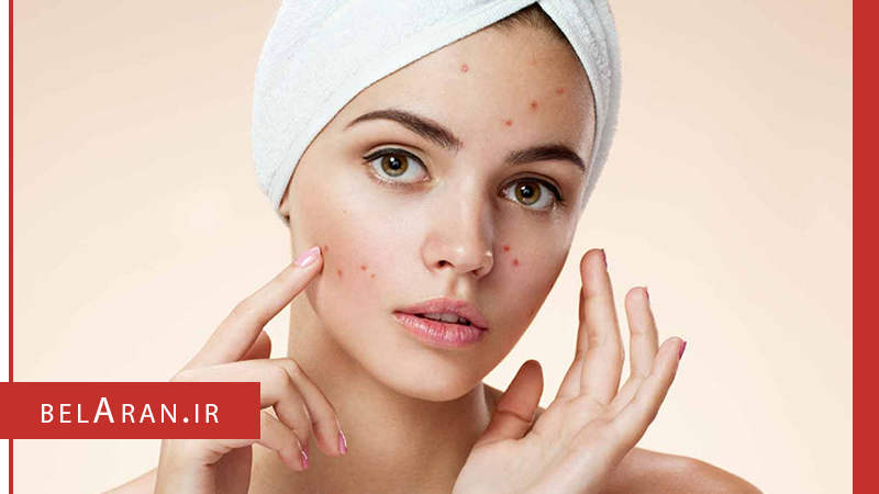 آیا می خواهید روش های طبیعی را برای درمان جوش های بعد از اصلاح امتحان کنید؟ - بلاران