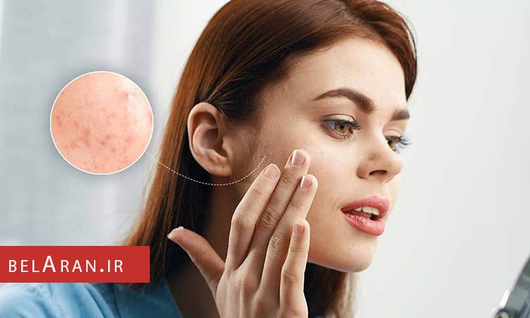 راه هایی برای پیشگیری ازجوش زدن قبل از اصلاح صورت - بلاران